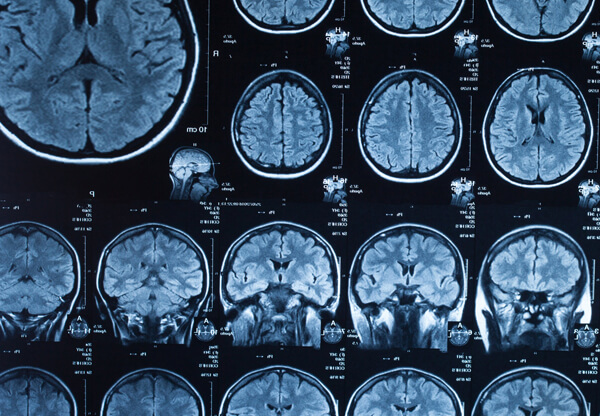 What Are The Different Severities Of Traumatic Brain Injury (tbi 